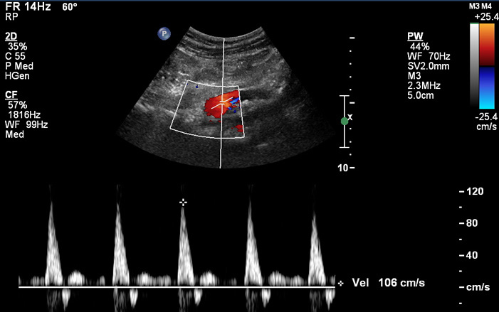 Abdominal Duplex Ultrasound