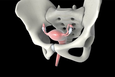 Cervical Cancer Treatment