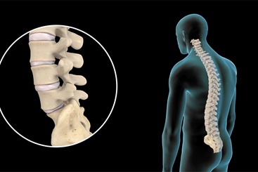 Lumbar Disc Injuries and Treatment