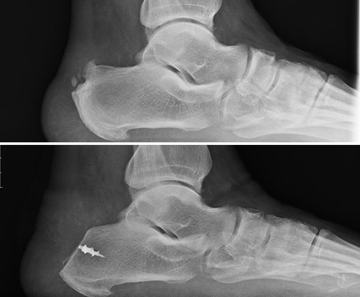 Posterior Heel Spur Diagnosed & Treated by Foot Surgeons - Mercy in  Baltimore