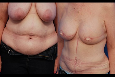 Breast Reconstruction - DIEP Flap - Before & After Photos
