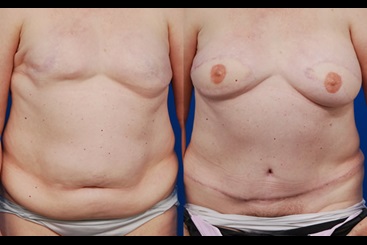 DIEP Flap Breast Reconstruction